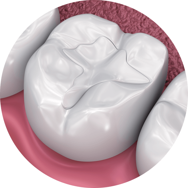 dental filling model