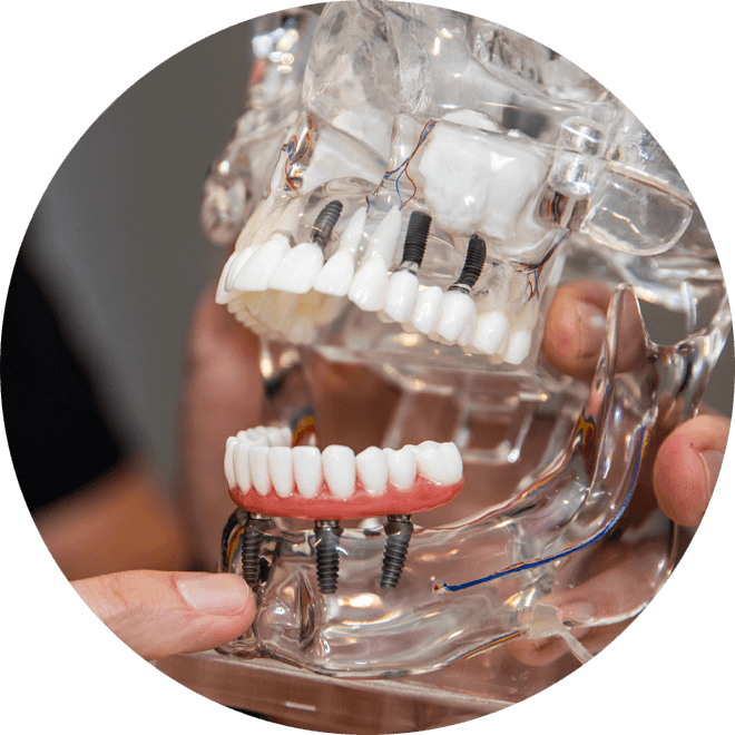 full arch dental implants model