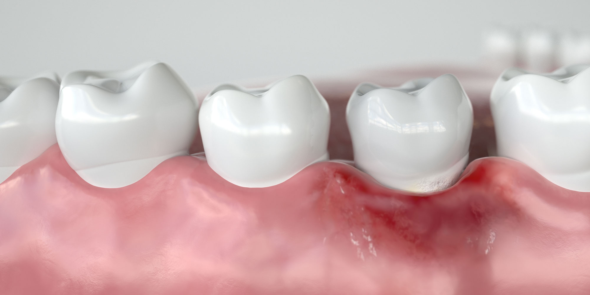 Gum Disease Lexington, KY Bluegrass Dentistry