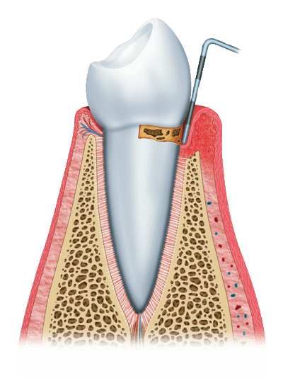 gum disease graphic stage