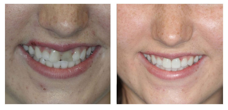 porcelain veneers before and after case