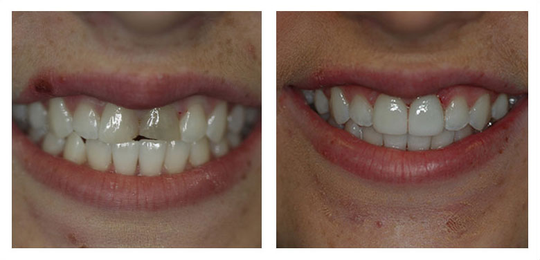 porcelain veneers before and after case