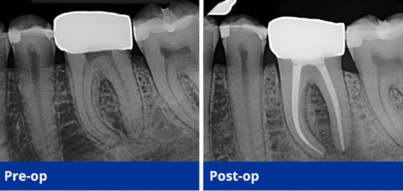 root canal graphic before and after