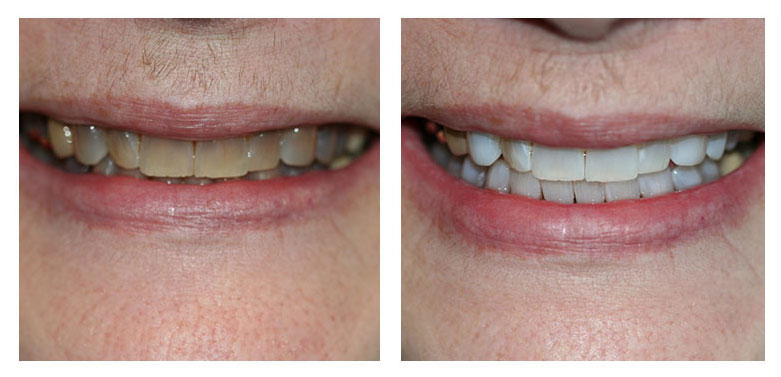 teeth whitening before and after