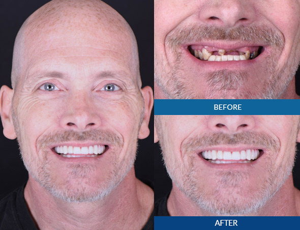 Bald male dental implant before and after