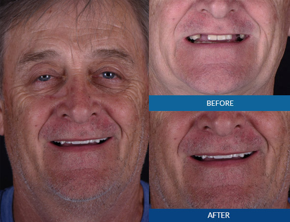 Male dental implant before and after