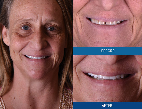 Female dental implant before and after