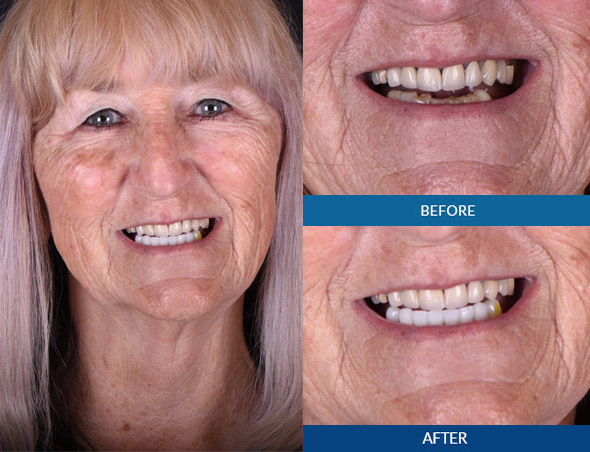 Female dental implant before and after