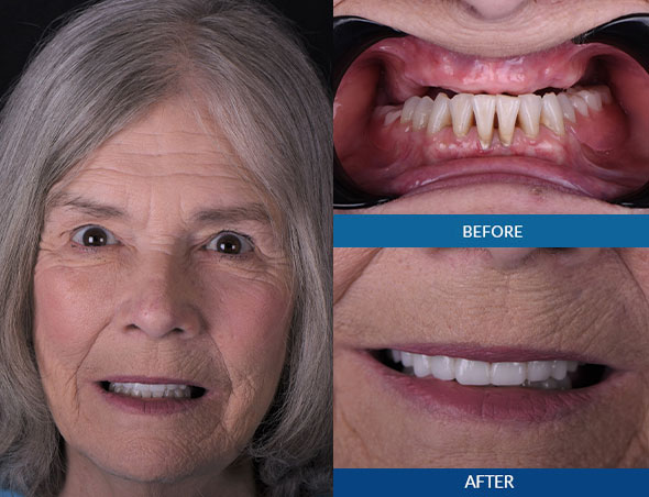 dental patient smiling after dental implants procedure