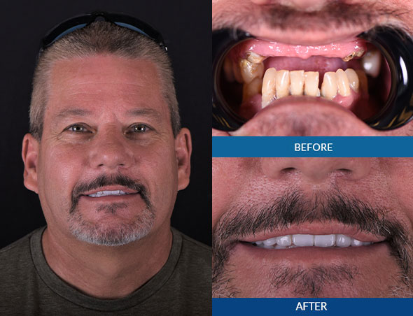 dental patient smiling after dental implants procedure