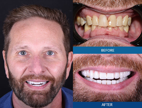 dental patient smiling after dental implants procedure