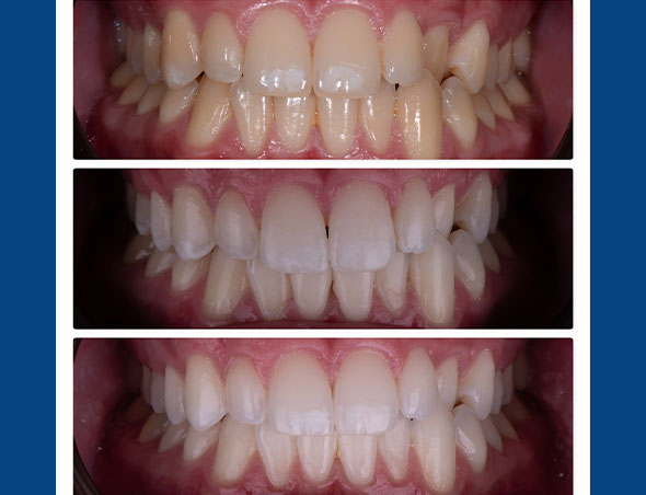 teeth whitening before and after