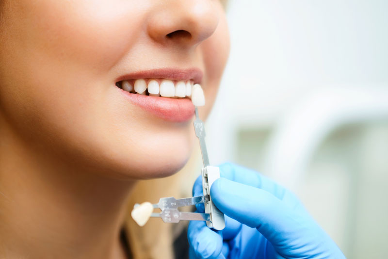 Doctor color matching a veneer for a patient’s tooth; holding device up to patients’ mouth