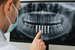 Close up of a dentist pointing to dental implants on a digital x-ray. No text on image.